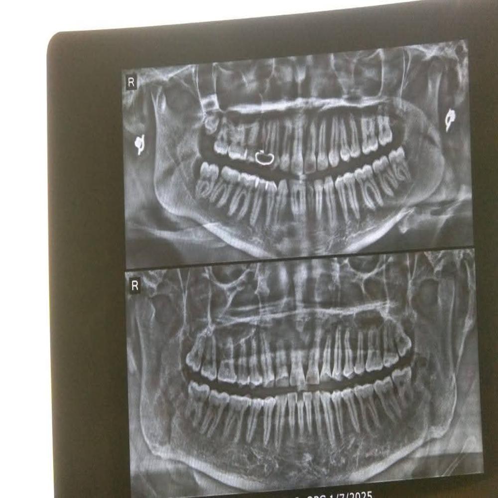 Dental Opg Machine