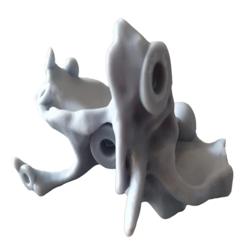 Printing Services of Patients' Anatomy Aids in Surgical Planning