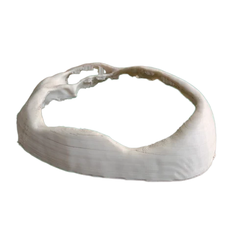 Printing Services of Patients' Anatomy Aids in Surgical Planning