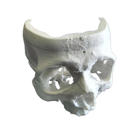 Printing Services of Patients' Anatomy Aids in Surgical Planning