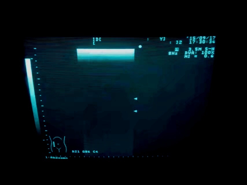 Aloka UST-5046-3.5 Ultrasound Transducer