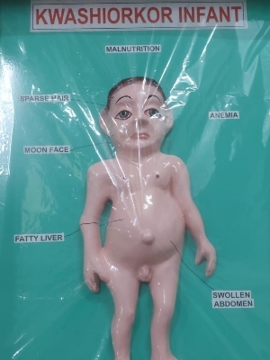 KYREX Kwashiorkor Infant Model
