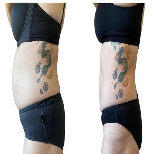 Cryo Lipo Laser - Accuracy: 100 %