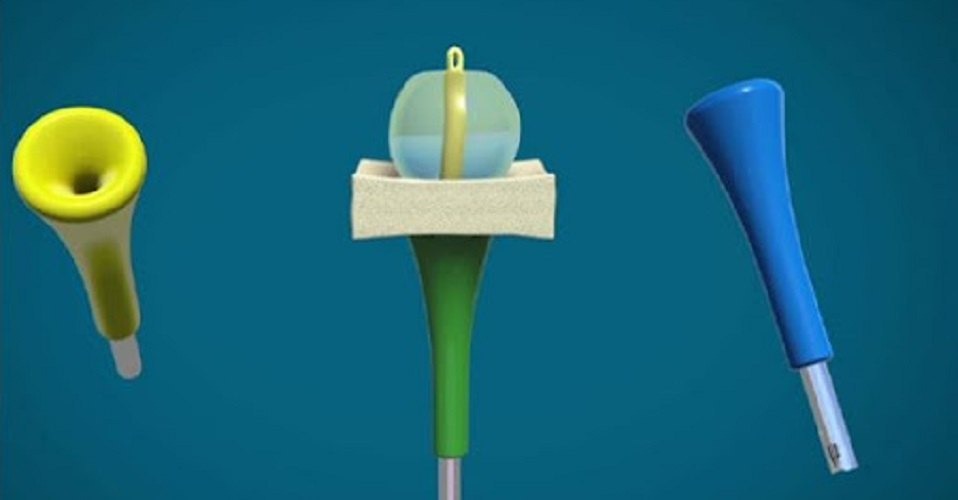 Panicker's Rapid Cervical Ripening Device