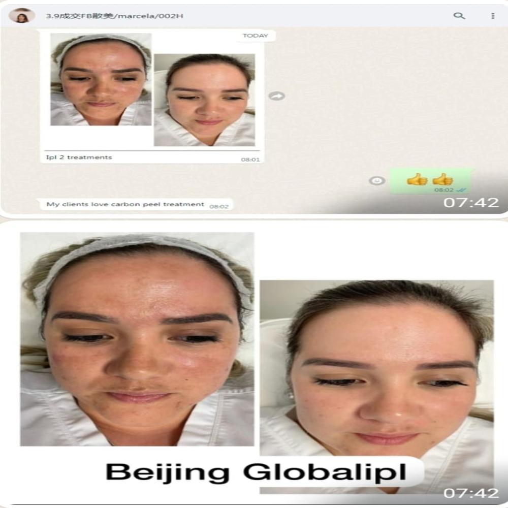 Global Laser Ipl Machine - Color: White