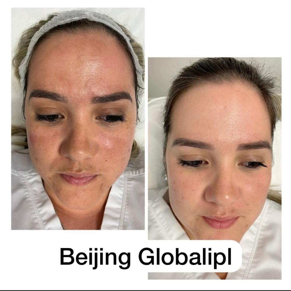 Global Laser IPL Machine