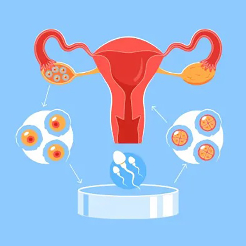 इन विट्रो निषेचन (IVF)