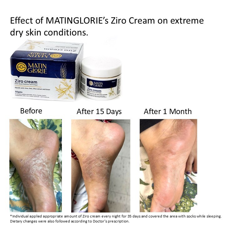 Ziro Cream For Cracked Heels and Extreme Dry Skin