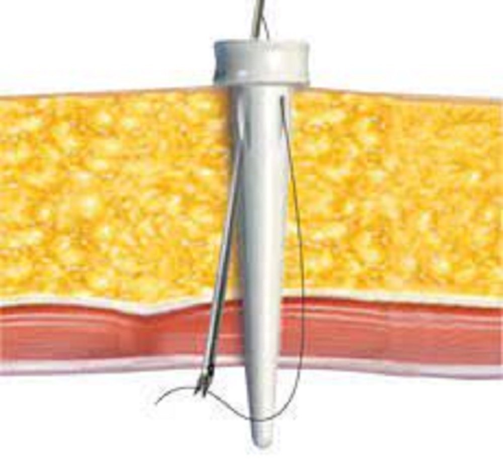 Carter Thomason Close Sure System Port Closure Needle