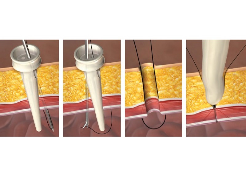 Carter Thomason Close Sure System Port Closure Needle