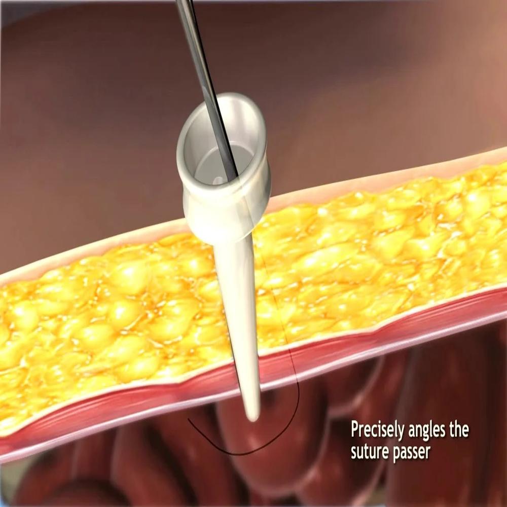 Carter Thomason Close Sure System Port Closure Needle