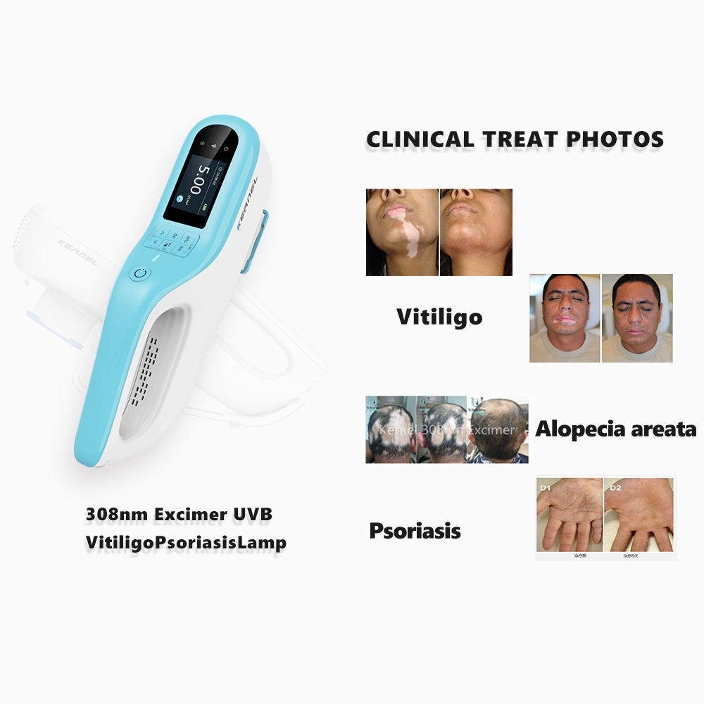 308Nm Excimer Laser Light Therapeutic Equipment - Attributes: High Quality