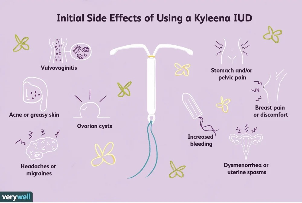 Kyleena IUD Levonorgestrel Intrauterine intrauterine device IUD Kyleena IUD