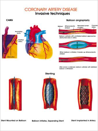 Coronary Artery Disease Charts