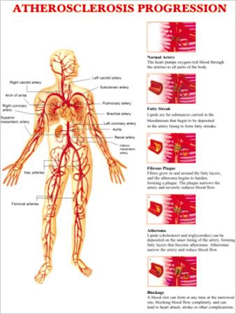 Atherosclerosis Posters