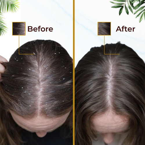 Anti Dandruff Conditioner