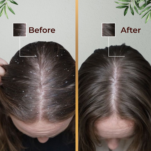 Anti Dandruff Shampoo