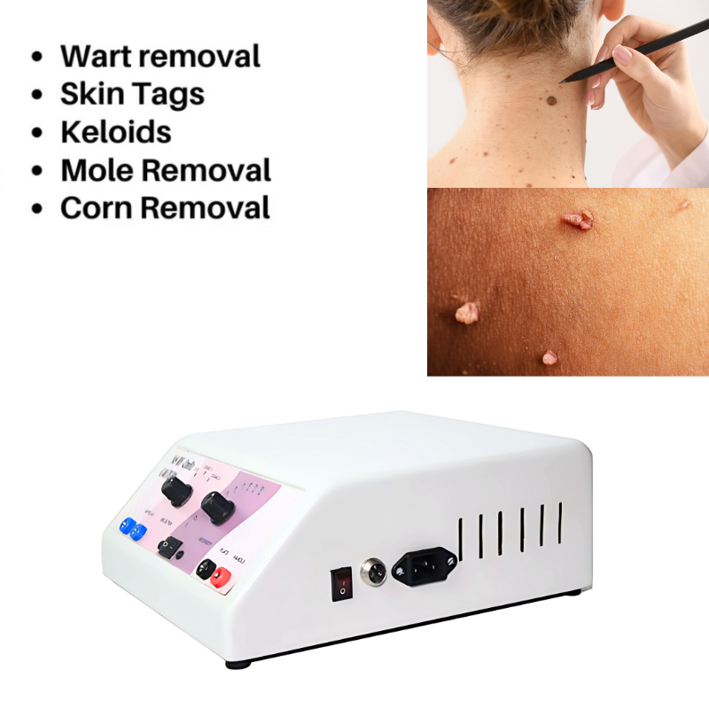 Radio Frequency Cautery