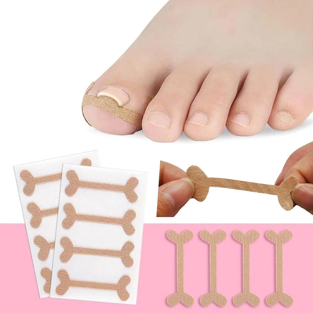 Ingrown Toenail Corrector Stickers - Medical-grade Non-woven Fabric, 6x1.8 Cm, White | Hypoallergenic, Waterproof, Breathable, Strong Grip, Pain Relief