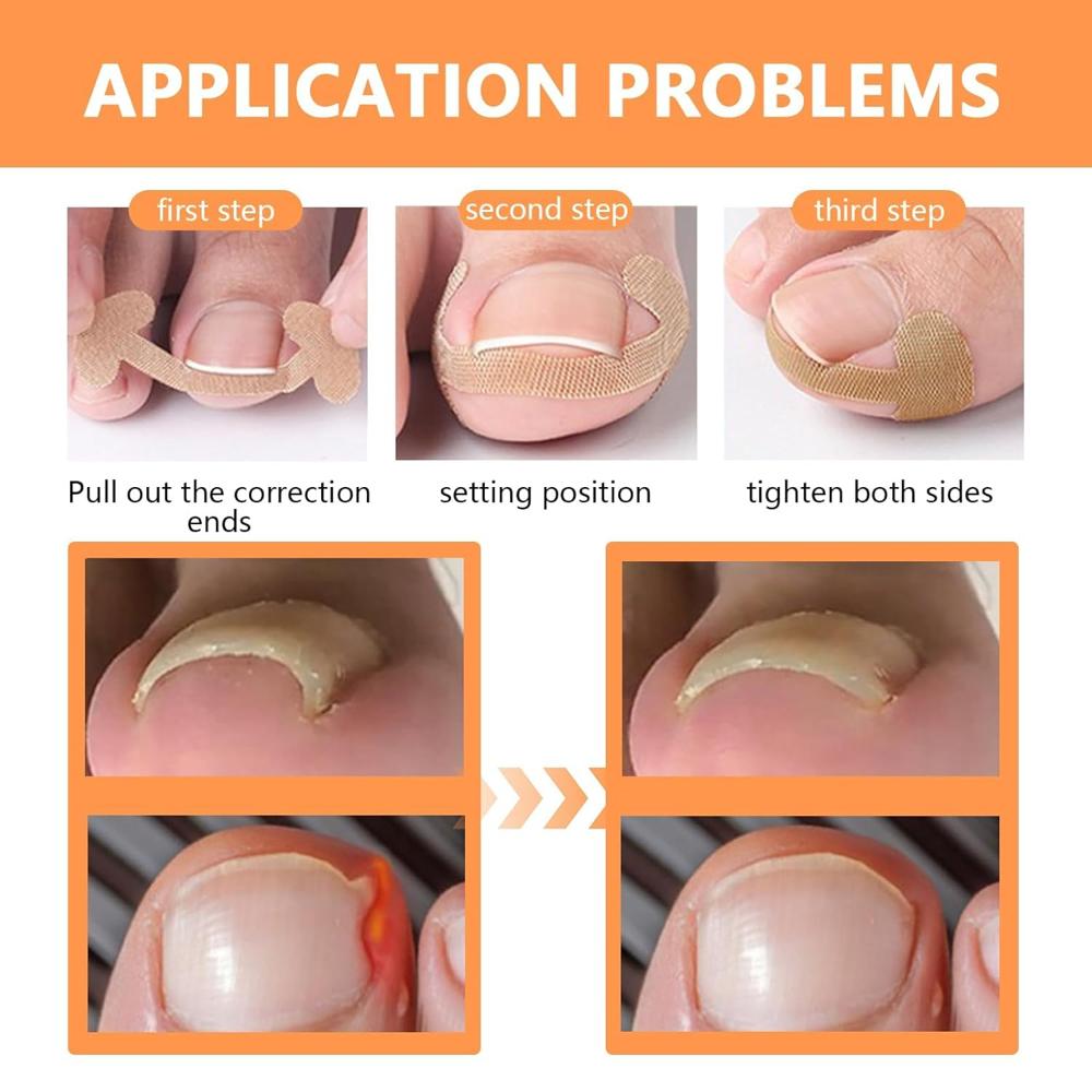Ingrown Toenail Corrector Stickers