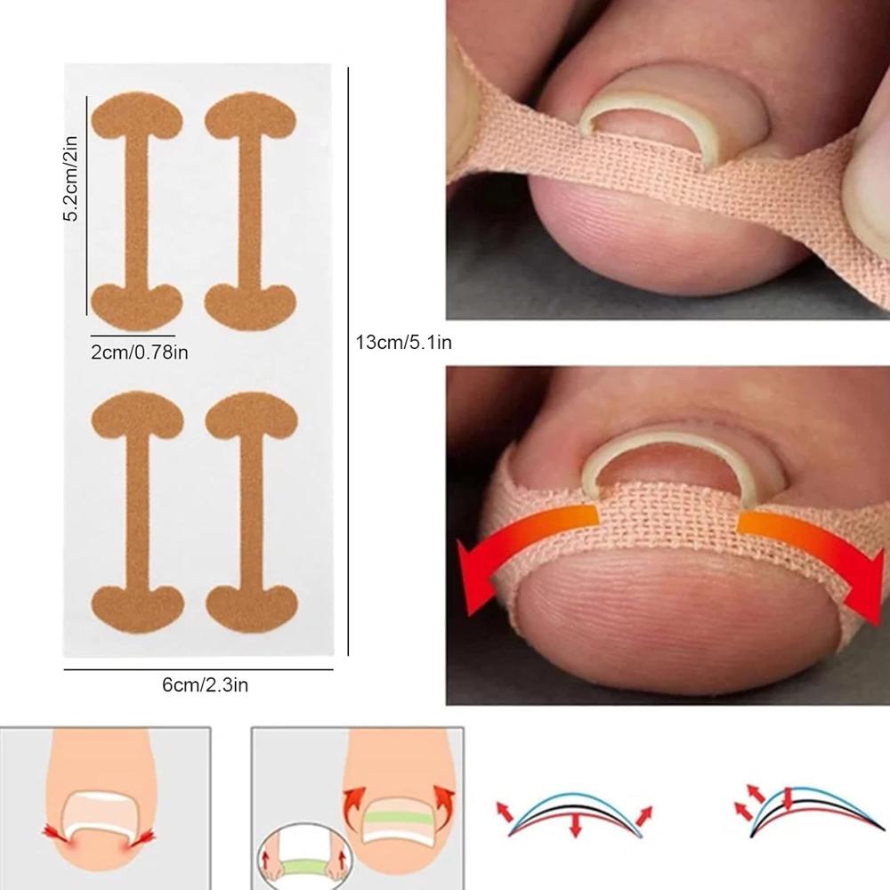 Ingrown Toenail Corrector Stickers