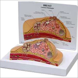 स्किन ब्रेस्ट कैंसर मॉडल