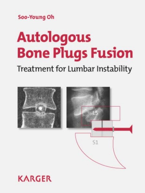 Autologous Bone Plugs Fusion Book