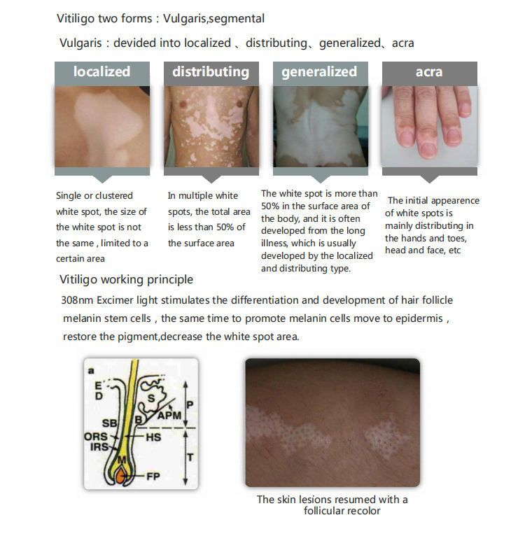 MZAS Excimer laser vitiligo