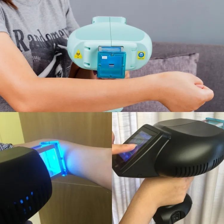 MZAS Excimer laser vitiligo