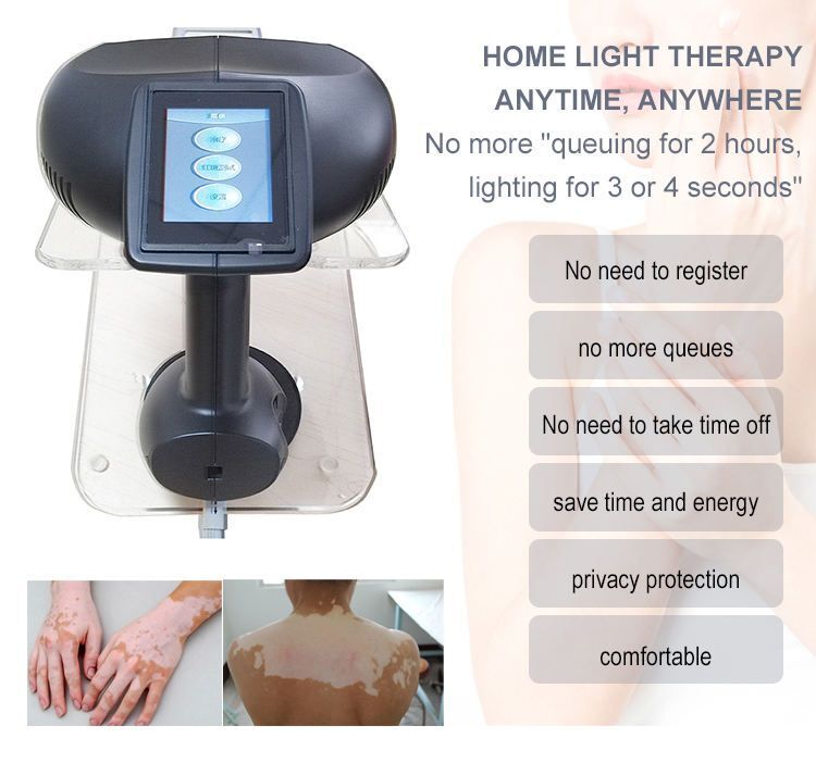 MZAS Excimer laser vitiligo