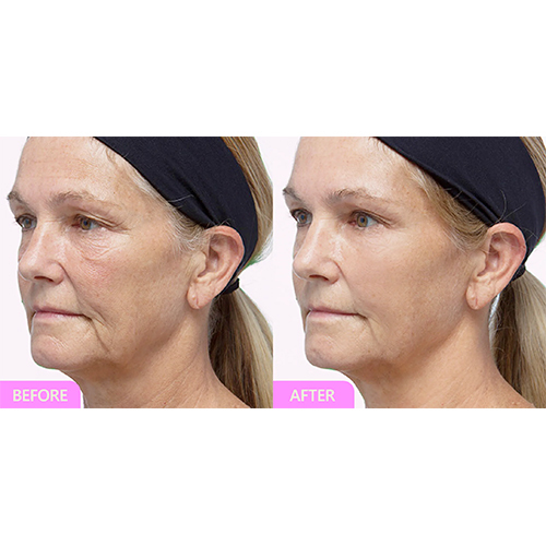 Anti Aging
