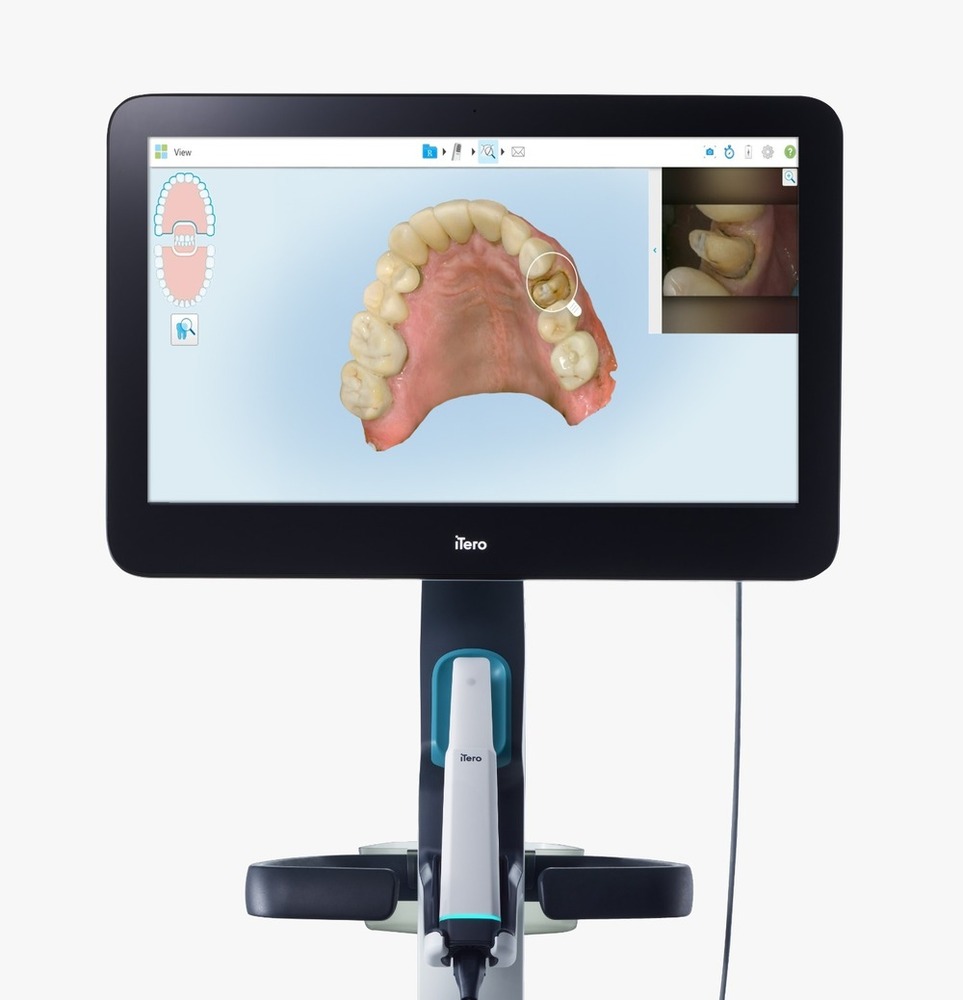 Itero Lumina Intraoral Scanner