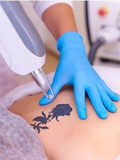 Tattoo Removal Laser