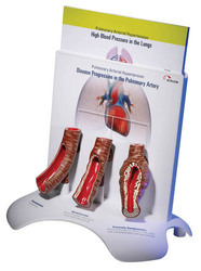 Pulmonary Arterial Hypertension Model - Color: Skin