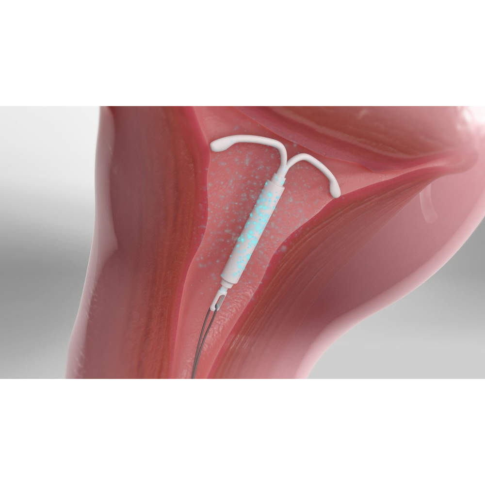 Emily T shaped Emily Levonorgestrel Intrauterine Device Hormone releasing Intra Uterine System