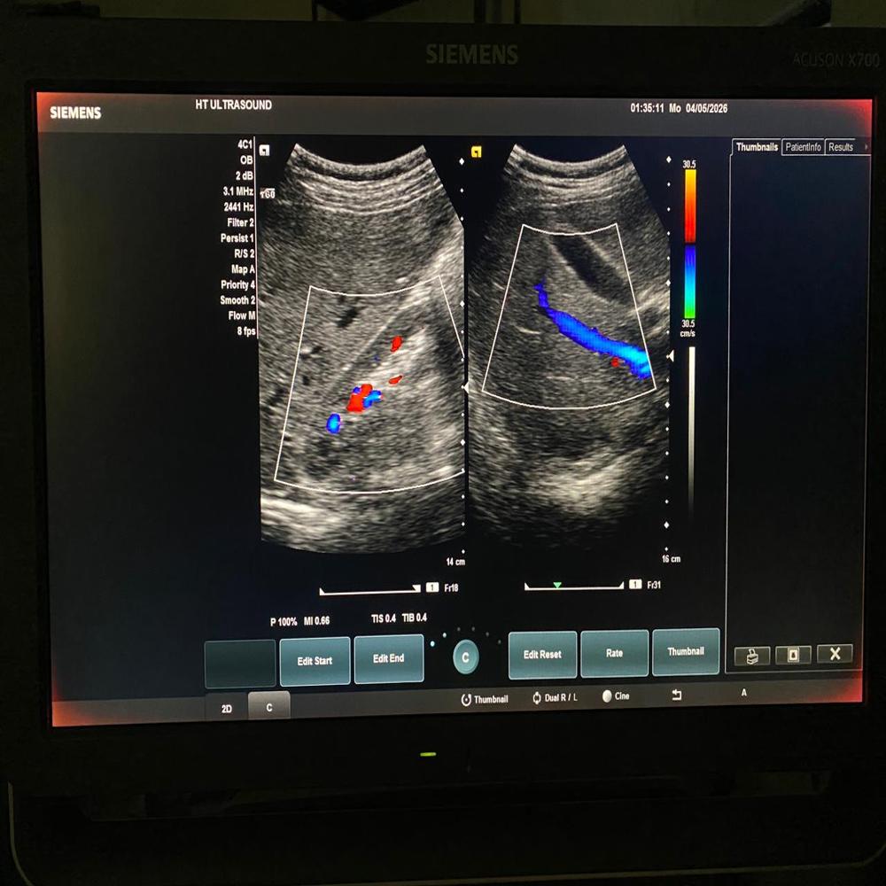 Siemens X700 Ultrasound Machine