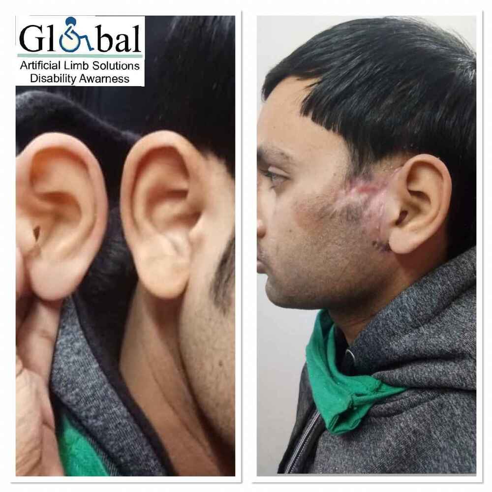 Customise Artificial Ear - German Silicon, Flexible & Waterproof Design , Foldable & Recyclable For Personal Use