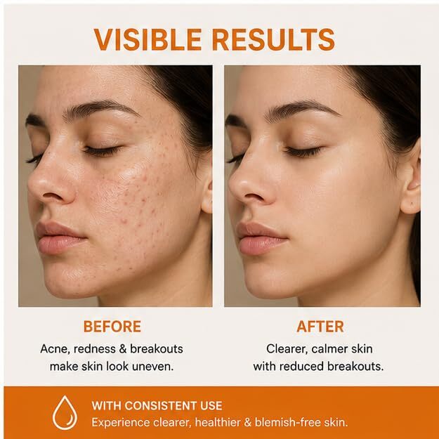 Elyndra Anti Acne Face Serum