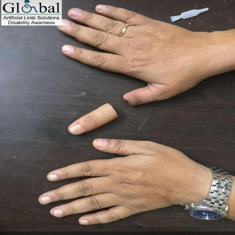 Osseointegration Finger Prosthesis