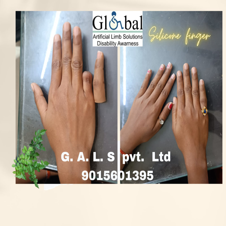 Osseointegration Finger Prosthesis