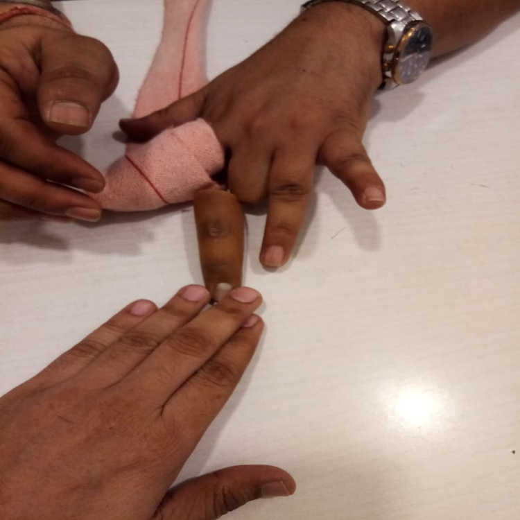 Osseointegration Finger Prosthesis