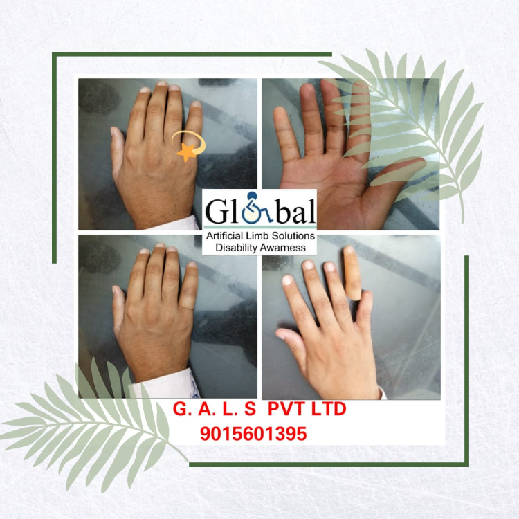 Osseointegration Finger Prosthesis