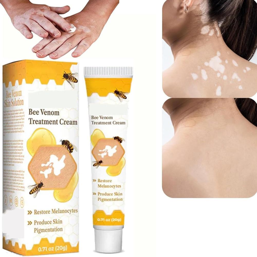 20g Vitigo Bee venm cream