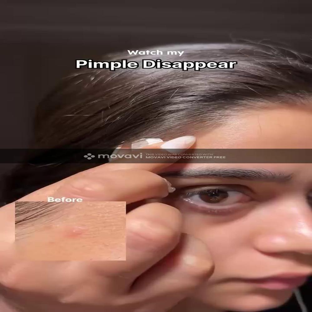Electronic Acne Patches