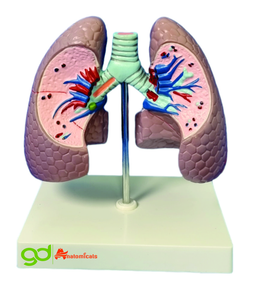 Lungs Pathology - Assembly: Ready To Use