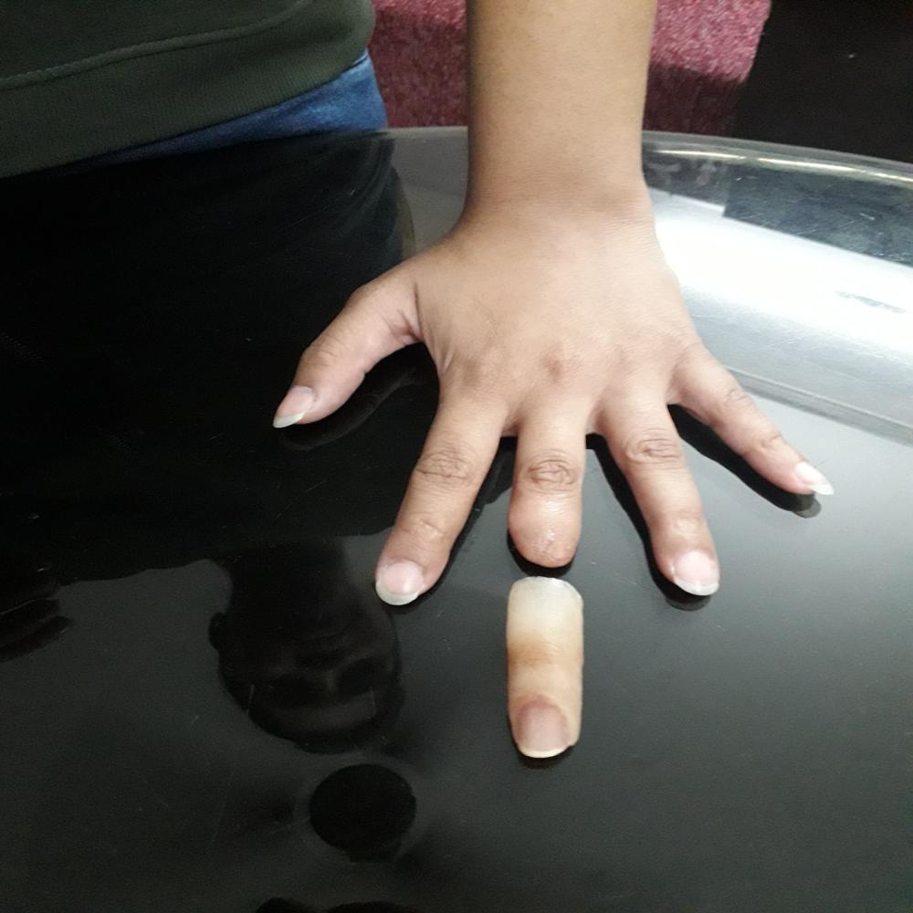 सिलिकॉन अंगूठे का प्रोस्थेसिस - रेयान रेहाब
