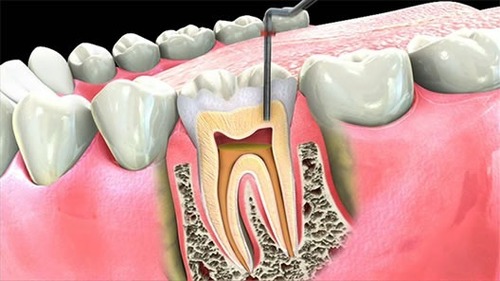 रूट कैनाल उपचार सेवाएँ