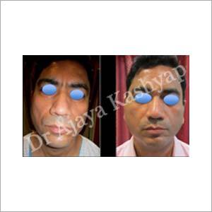 चेहरे की कॉस्मेटिक सर्जरी