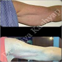 ब्रैकीप्लास्टी आर्म लिफ्ट सर्जरी