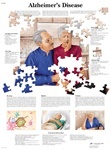 Plaque In Alzheimer's Brain at Murray Baxter blog